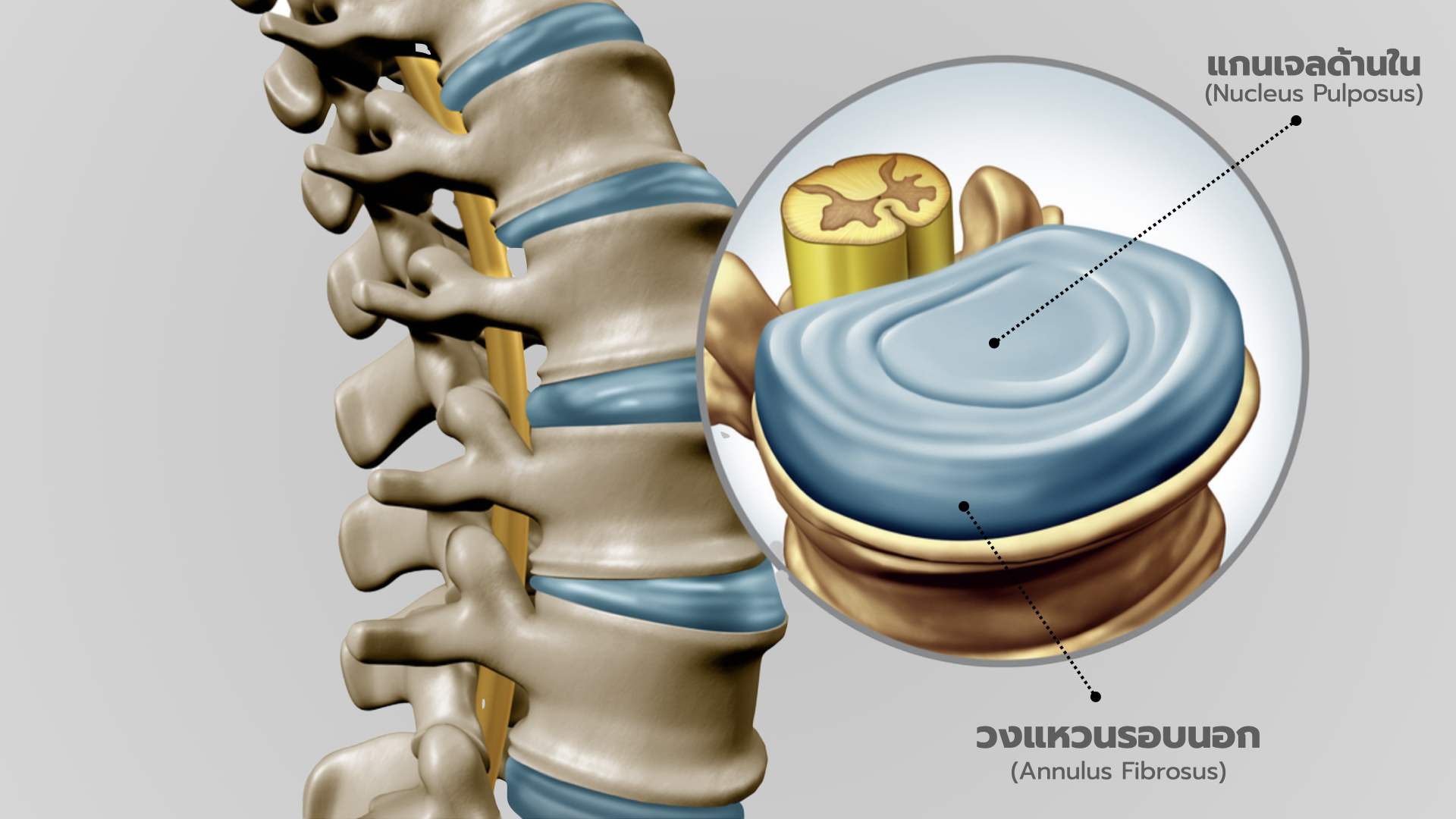 หมอนรองกระดูกทับเส้นประสาท (Herniated nucleus pulposus) 