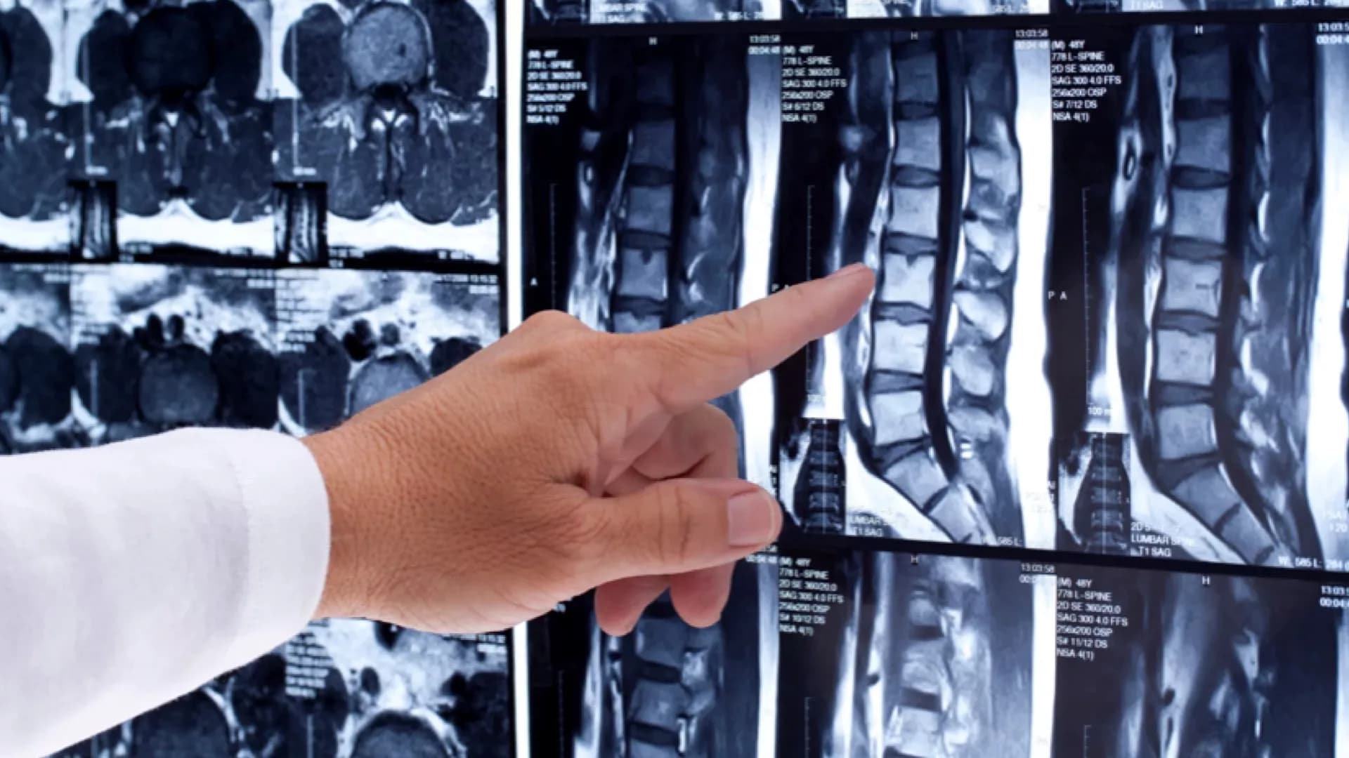 ทำไมแพทย์เลือกใช้ MRI ในการตรวจโรคกระดูกสันหลัง