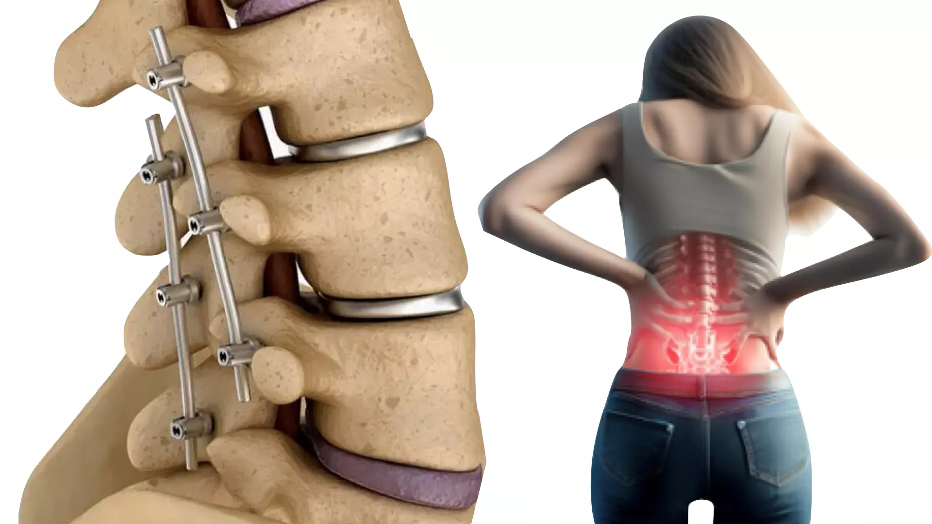 การผ่าตัดเชื่อมข้อกระดูกสันหลังด้วยกล้องเอ็นโดสโคปแบบแผลเล็ก เจ็บน้อย ฟื้นตัวเร็ว 